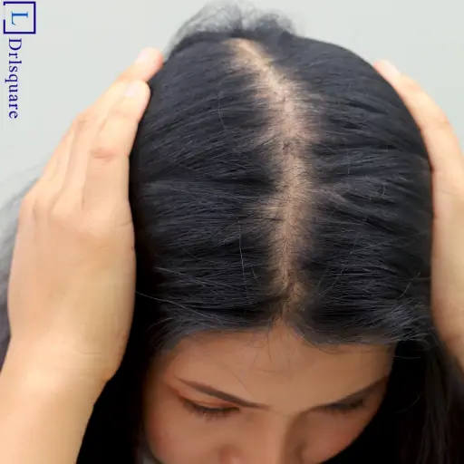 Homeopathic treatment for alopecia areata at Dr. L Square Multispecialty Homeopathy Clinic in Kolaghat.