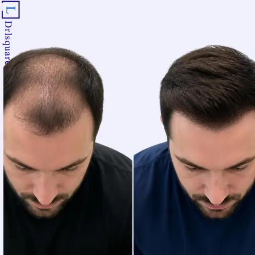 Male pattern baldness treatment results at Dr. L Square Multispecialty Homeopathy Clinic in Kolaghat.