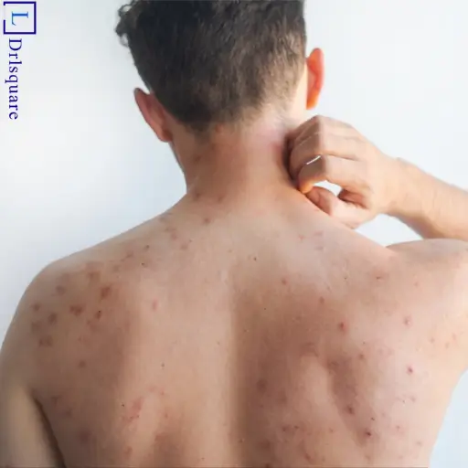 Common symptoms of psoriasis explained by Dr. L Square Multispecialty Homeopathy Clinic in Kolaghat.