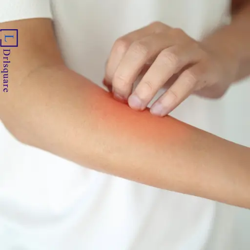 Common symptoms of skin eczema explained by Dr. L Square Multispecialty Homeopathy Clinic in Kolaghat.