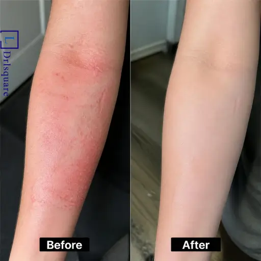 Skin eczema treatment results at Dr. L Square Multispecialty Homeopathy Clinic in Kolaghat.