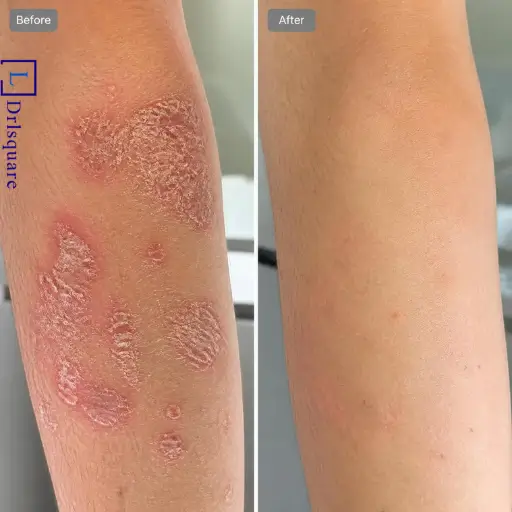Skin Psoriasis treatment results at Dr. L Square Multispecialty Homeopathy Clinic in Kolaghat.