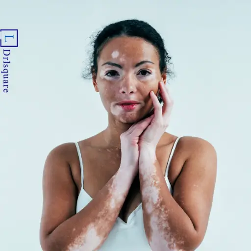 Common causes of vitiligo explained by Dr. L Square Multispecialty Homeopathy Clinic in Kolaghat.