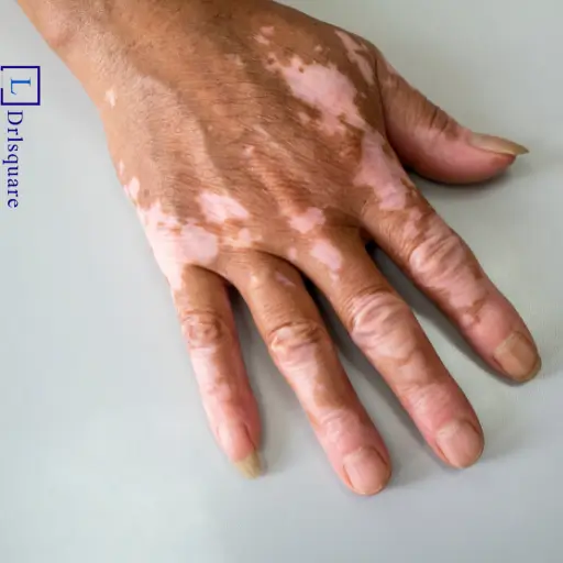 Homeopathic treatment for vitiligo at Dr. L Square Multispecialty Homeopathy Clinic in Kolaghat.