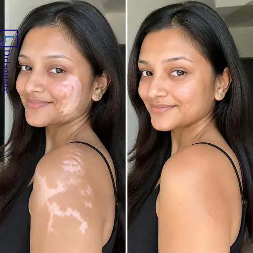Vitiligo treatment results at Dr. L Square Multispecialty Homeopathy Clinic in Kolaghat.