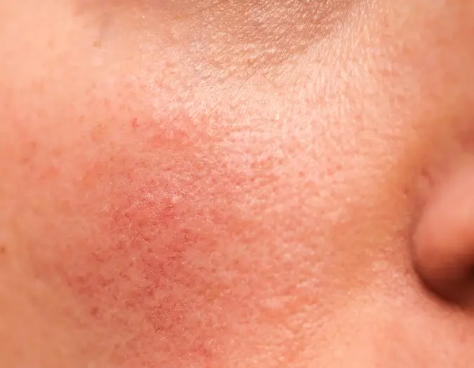 Painful cracked and inflamed skin from chronic eczema managed at Dr. L Square Multispecialty Homeopathy Clinic