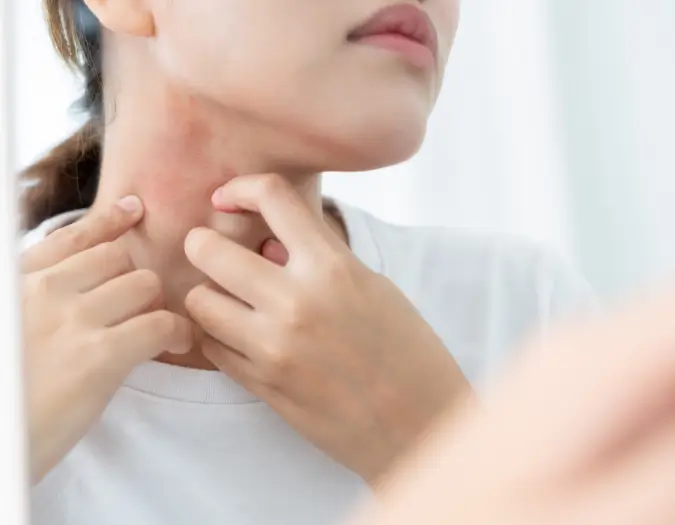 Widespread allergic skin rash patches from food sensitivity examined at Dr. L Square Multispecialty Homeopathy Clinic