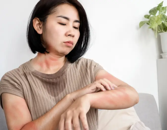 Raised red hives and itchy welts on skin triggered by food allergy evaluated at Dr. L Square Multispecialty Homeopathy Clinic