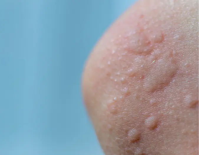 Raised red welts and hives on skin caused by allergic urticaria treated at Dr. L Square Multispecialty Homeopathy Clinic
