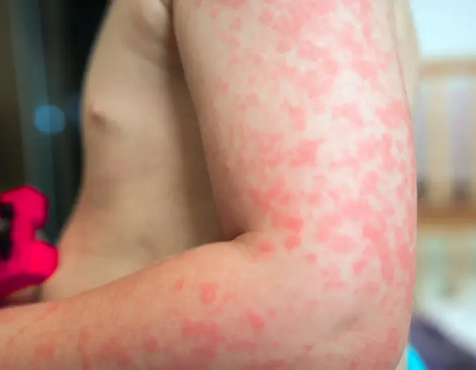 Patient receiving natural homeopathic skin allergy treatment for eczema and rashes at Dr. L Square Multispecialty Homeopathy Clinic