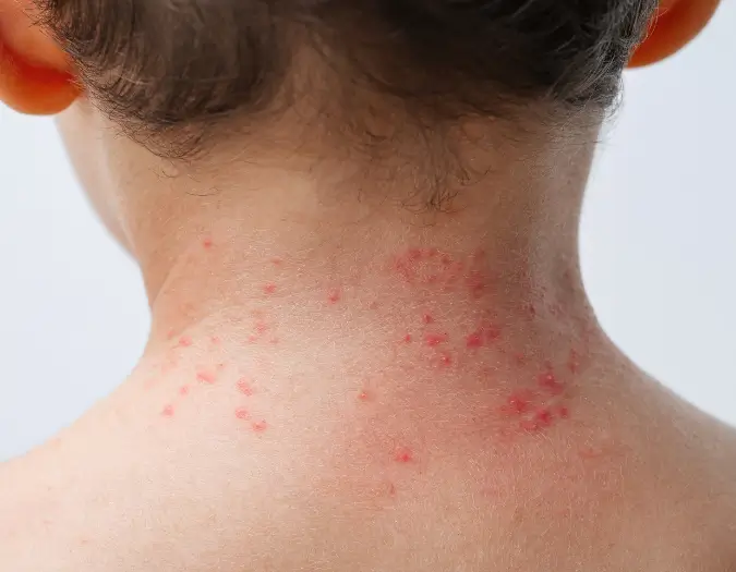 Red allergic skin rashes and patches on sensitive skin treated at Dr. L Square Multispecialty Homeopathy Clinic