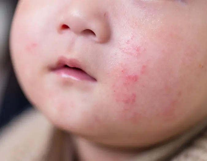 Localized skin redness and inflammation from contact allergy evaluated at Dr. L Square Multispecialty Homeopathy Clinic